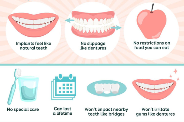 Benefits of Dental Implants